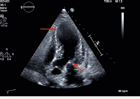 left ventricular hypokinesis